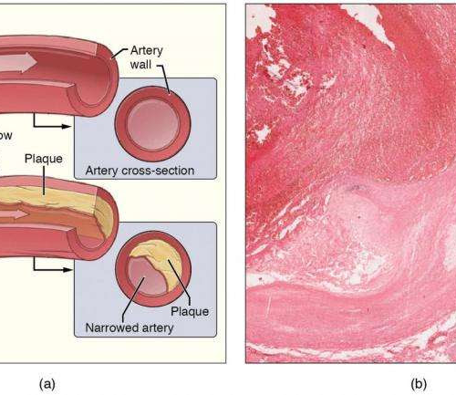 Metals in the body from pollutants associated with progression of harmful plaque buildup in the arteries