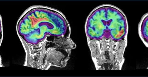 Understanding changes in pre-clinical Alzheimer’s disease: Study finds two proteins impact brain activity differently