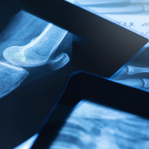 Toxic glass kills 99% of bone cancer without harming healthy cells