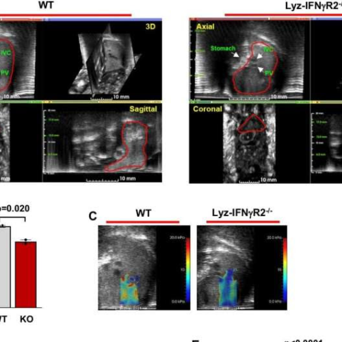 Novel pathway could lead to potential treatment for metabolic liver disease