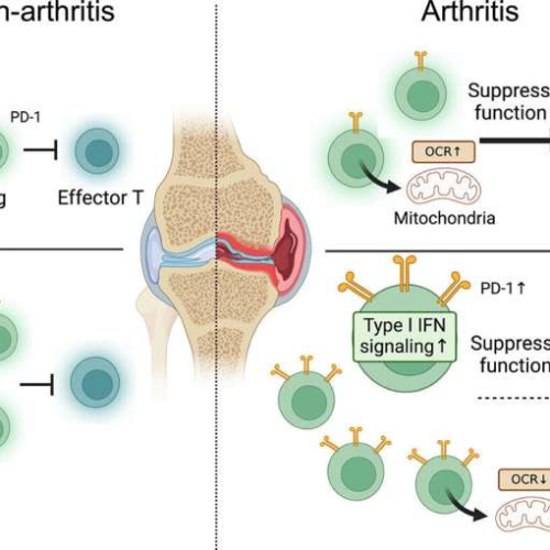 Uncovering the cause of regulatory T cell dysfunction in elderly-onset rheumatoid arthritis