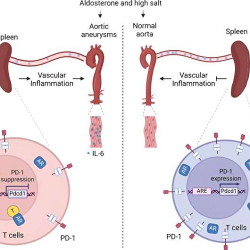 Understanding sex-specific differences in aortic aneurysms