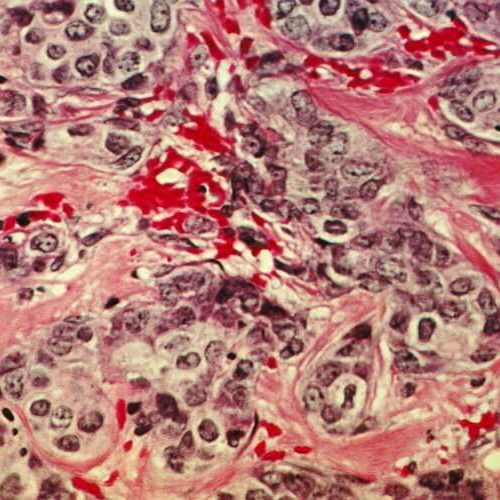 Study confirms fibrosis as a prognostic indicator in the most common breast cancer