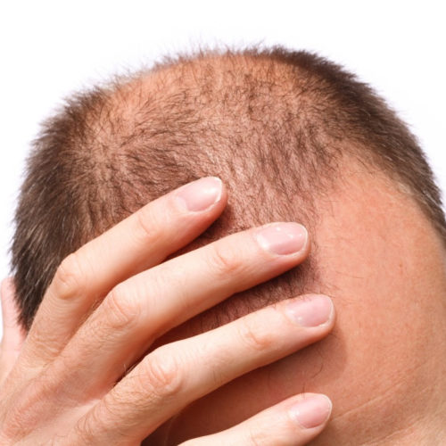 Stem cell topical solution for baldness offers positive trial results
