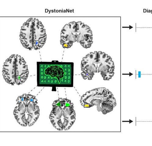 Artificial intelligence platform diagnoses dystonia with high accuracy in 0.36 seconds