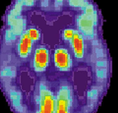 Tau protein changes correlate with Alzheimer’s disease dementia stage