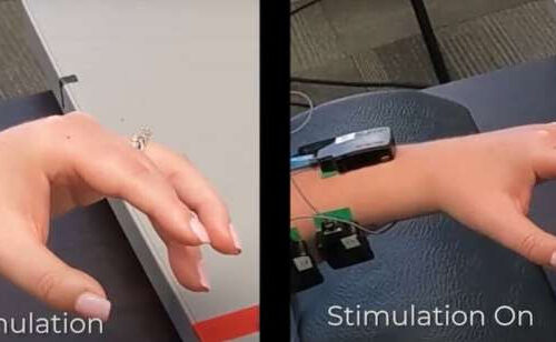 Spinal cord stimulation shown to instantly improve arm mobility after stroke