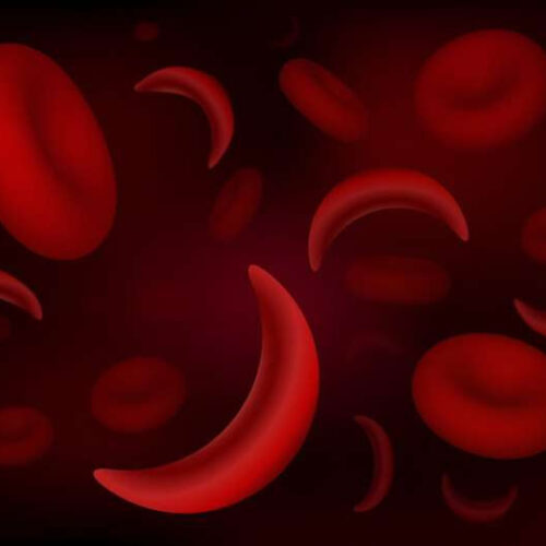 FDA advisors say new gene therapy for sickle cell disease is safe
