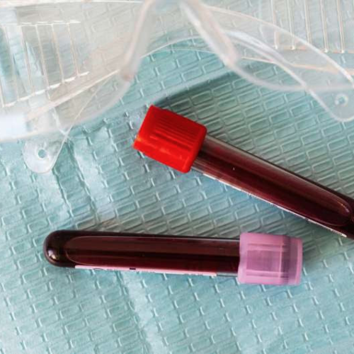 New evidence casts doubt on a much-hyped blood test for early cancer detection